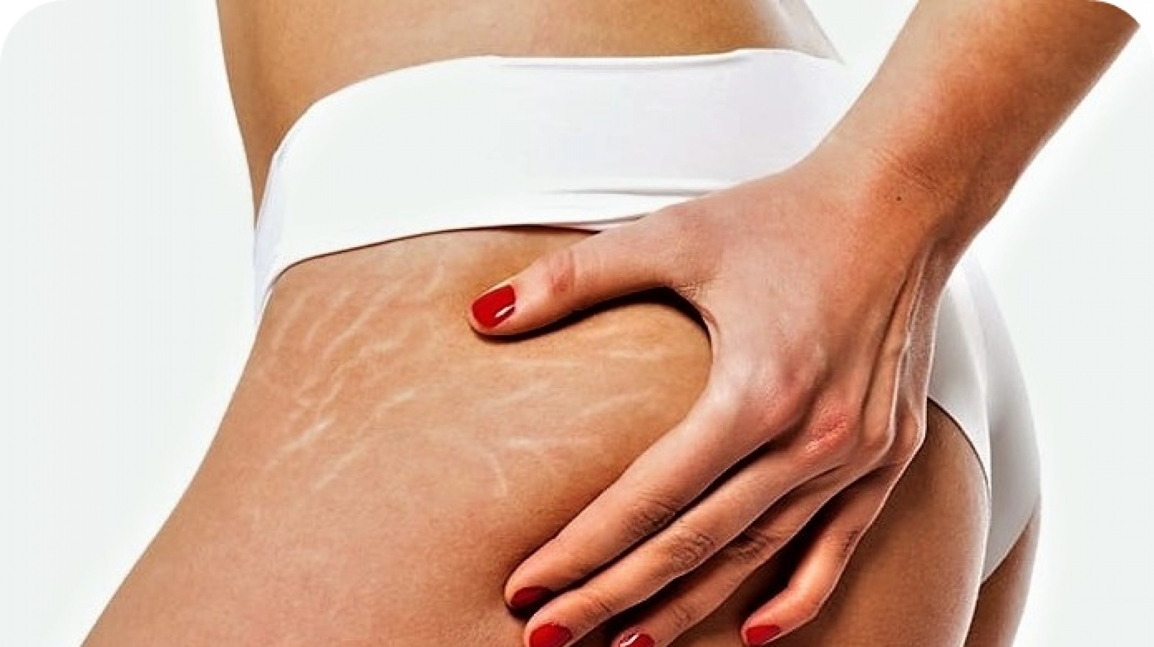 Dile adiós a las estrías con estos remedios naturales